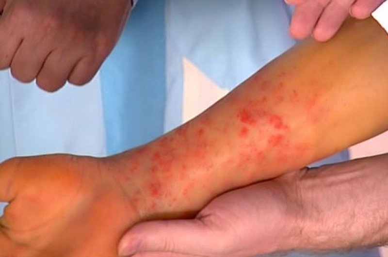 В Египте возникла вспышка лихорадки денге?