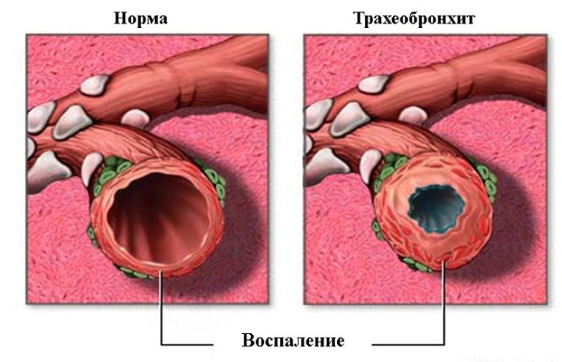 Трахеобронхит - 2