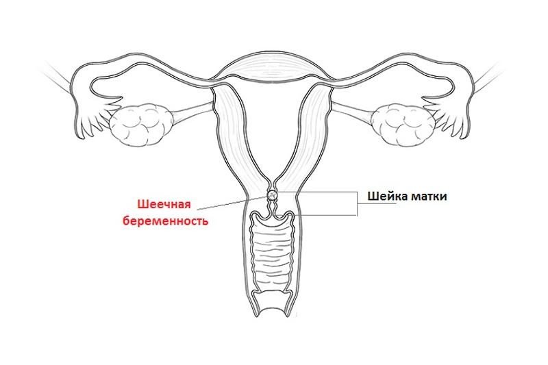 Шеечная беременность (шб) - 1