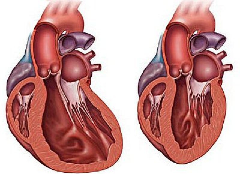 Дилатационная кардиомиопатия - 2