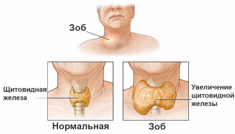 Зоб — первые признаки и симптомы, лечение зоба в Москве