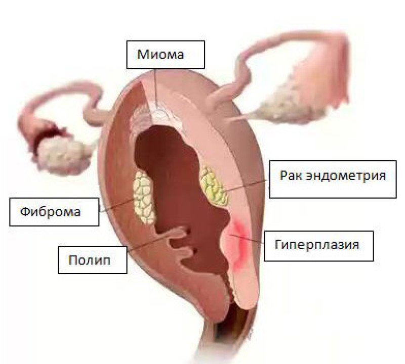 Рак эндометрия - 1