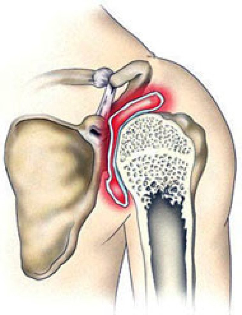 Артроз артрит плечевого сустава симптомы