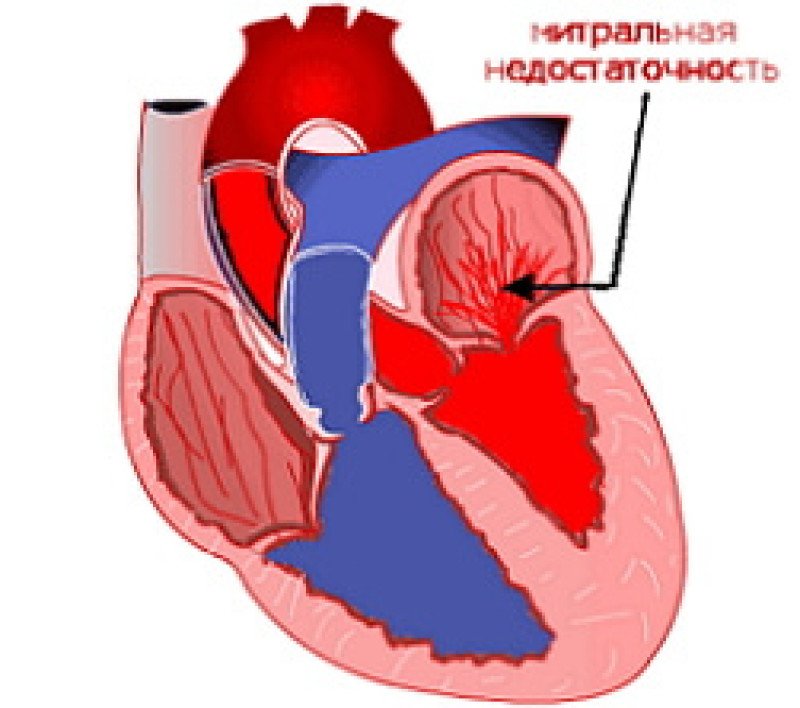 Митральная недостаточность: степени, симптомы, лечение