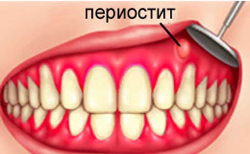 Периостит челюсти (пч) - 1