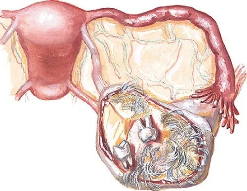 Яичник у мужчин лечение. Дермоидная киста яичника. Эндометриоидная киста яичника. Эндометриоидная киста яичников. Цистаденома яичника и эндометриоидная киста.