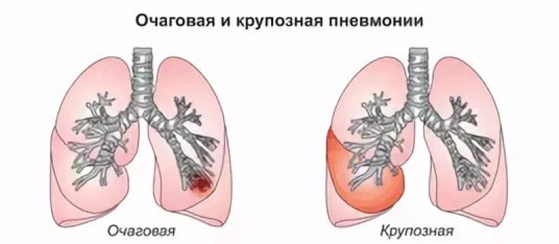 Очаговая  пневмония - 1