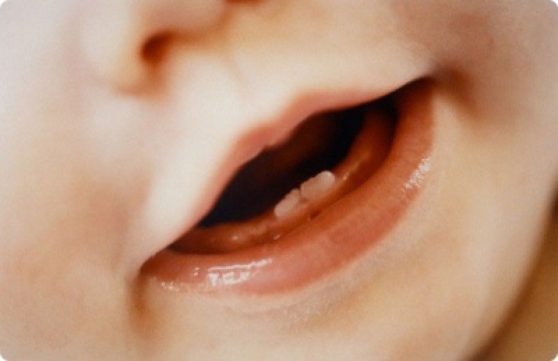 Прорезывание зубов у детей - 2
