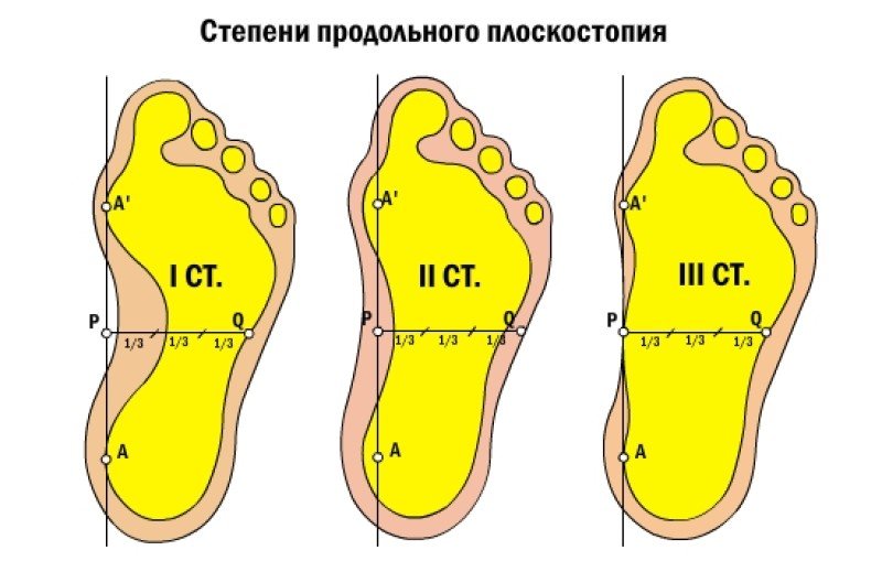 Плоскостопие ✔: симптомы, причины, диагностика и лечение