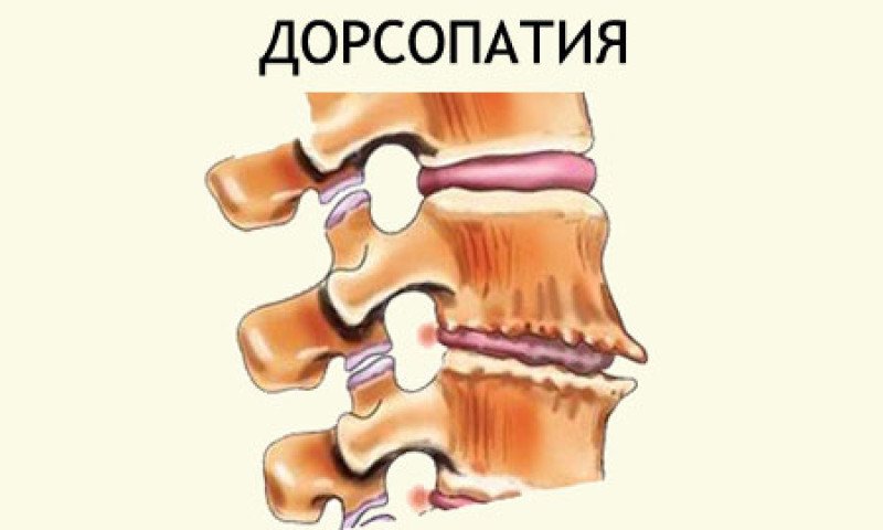 Дорсопатия - 1