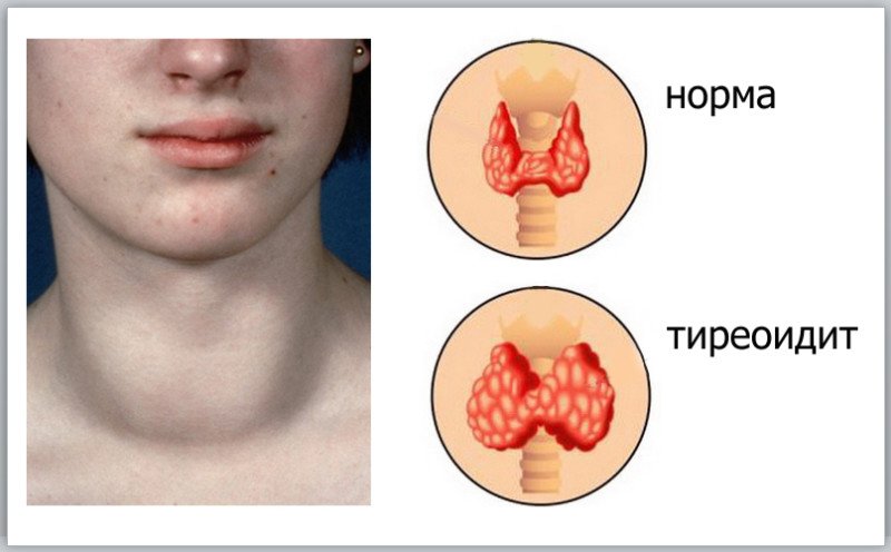 Тиреоидит - 2