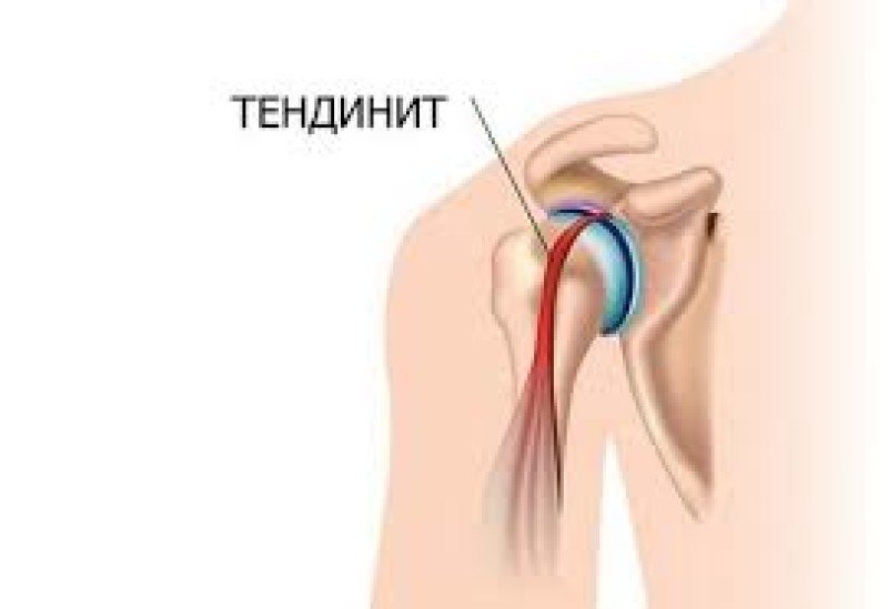Тендинит плечевого сустава - 1