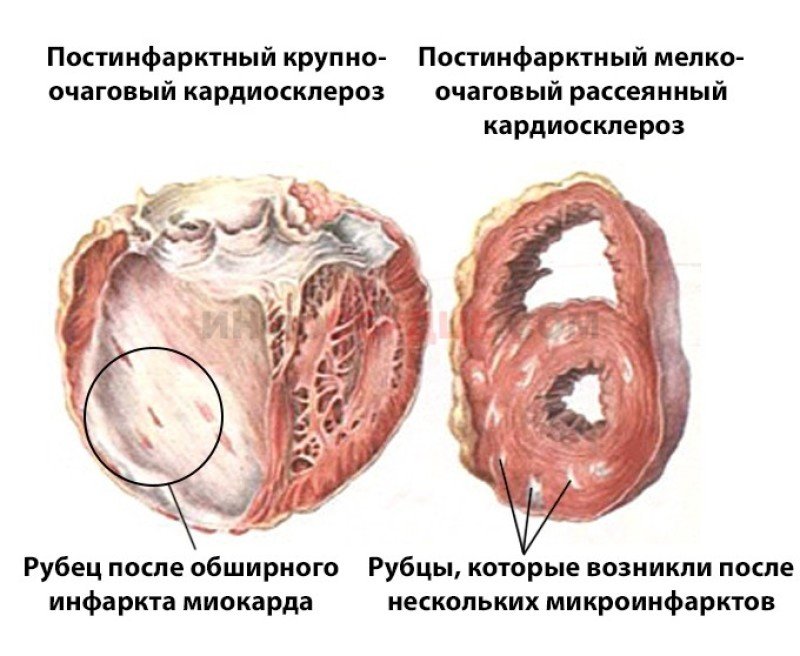 Постинфарктный кардиосклероз - 2