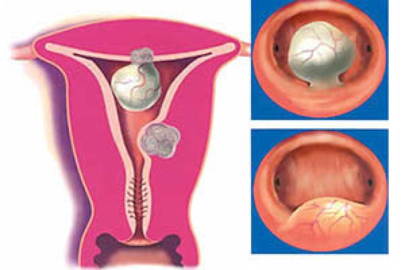 Миома в полости матки фото