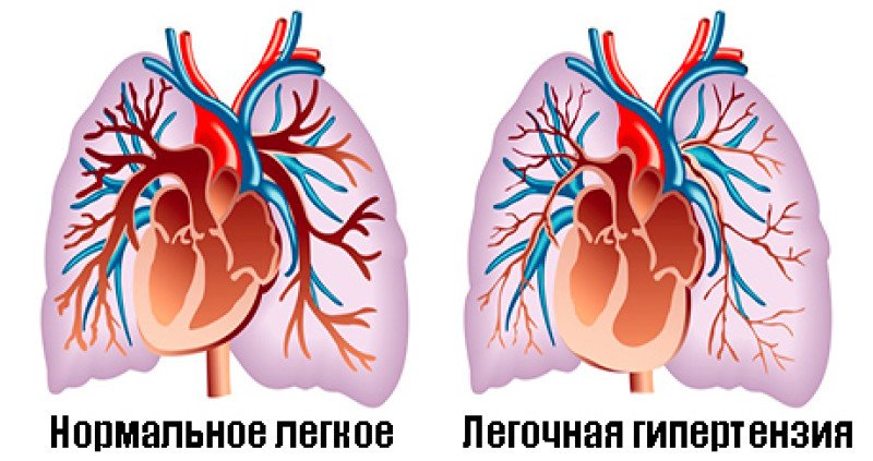 Лёгочная гипертензия - 2