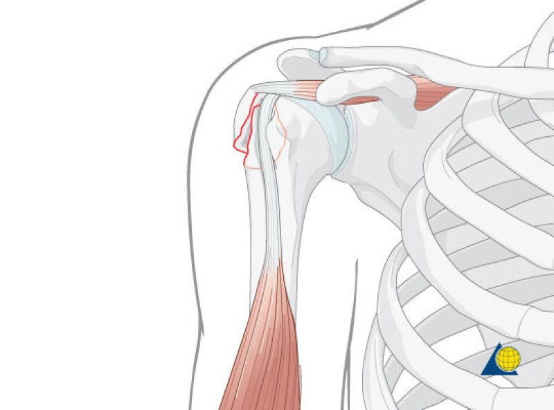 Перелом шейки плеча - 1