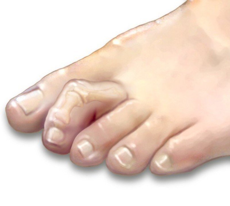 Скручиваются ноги почему. Ревматоидный артрит молоткообразная деформация. Молоткообразная деформация стопы. Молоткообразная деформация пальцев ног. Молоткообразная деформация 2 пальца стопы.