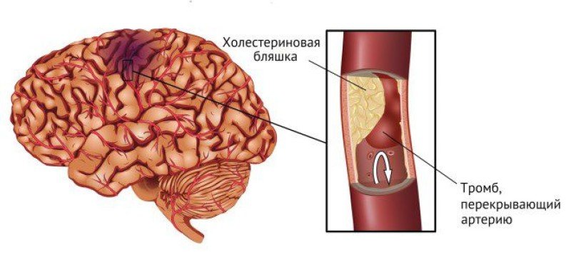 Хроническая ишемия головного мозга - 1