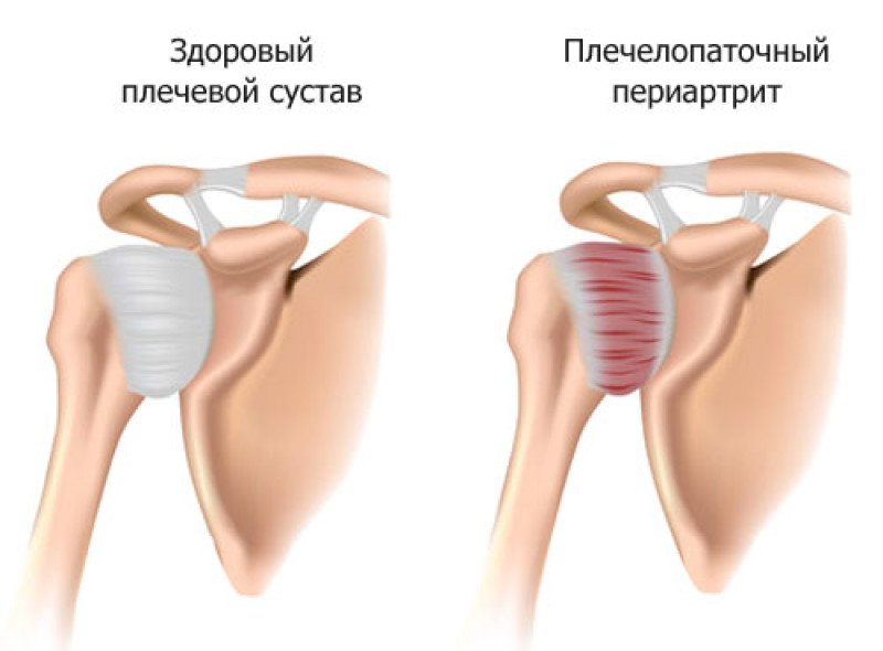 Плечелопаточный периартрит - 1