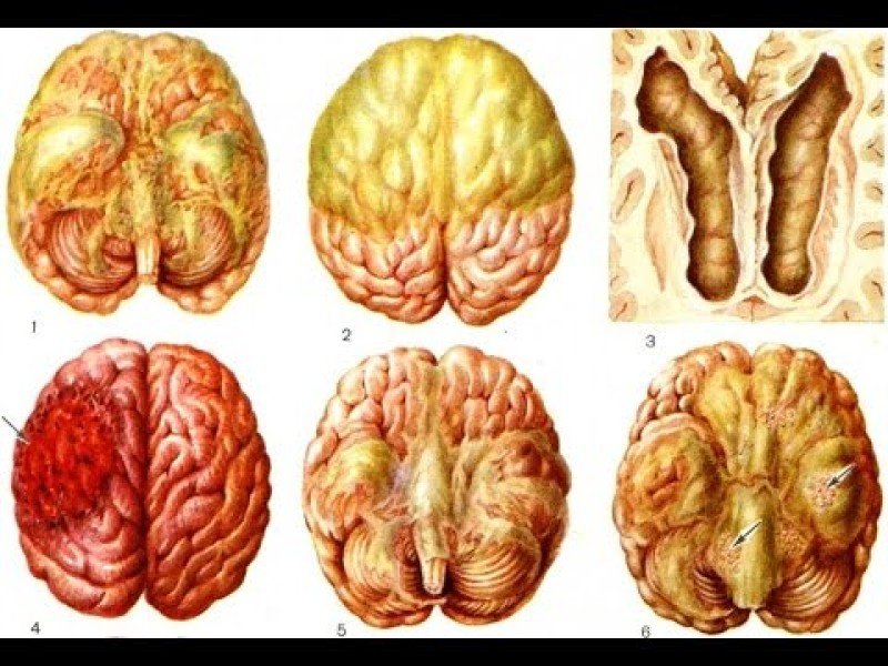 Гнойный менингит - 1