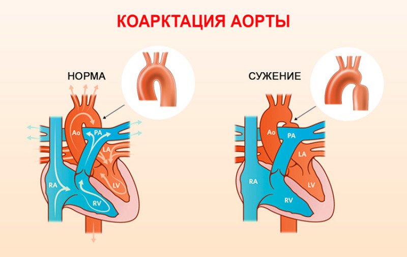 Коарктация аорты - 1