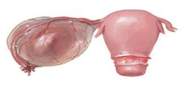 Параовариальная киста - 1