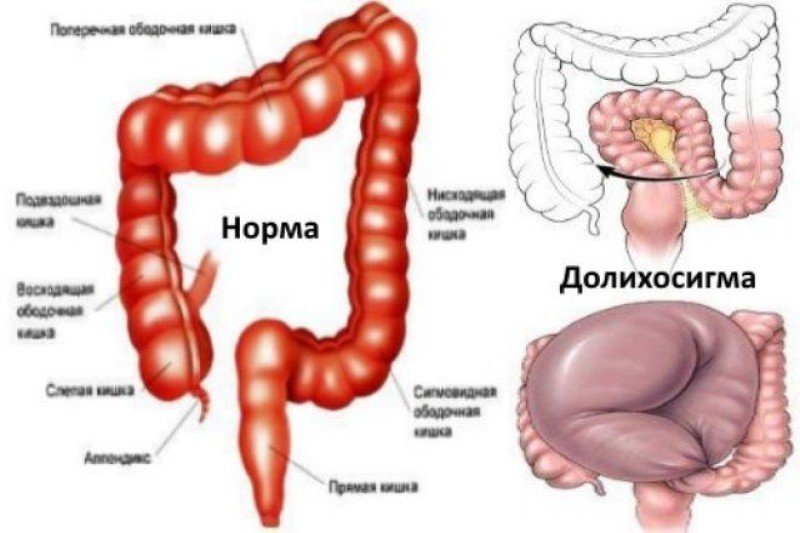 Долихосигма - 1