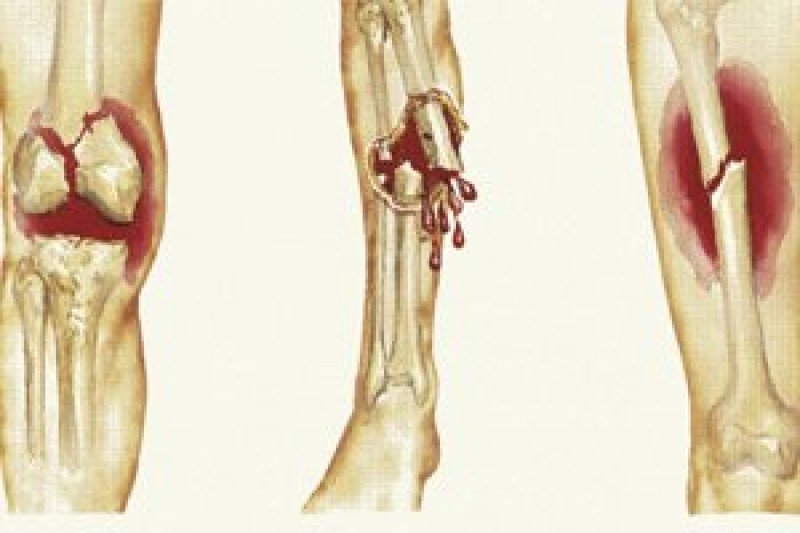 Перелом пяточной кости: лечение и восстановление после травмы