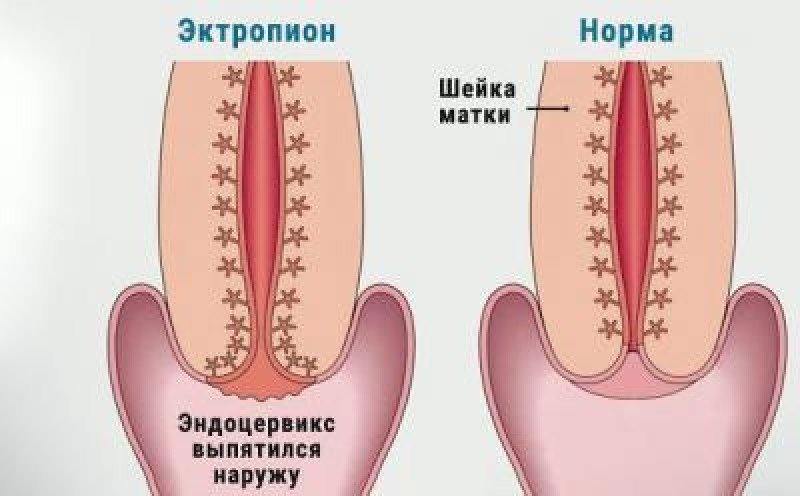 Эктропион шейки матки - 2