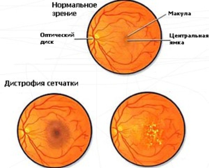 Дистрофия сетчатки глаза - 2