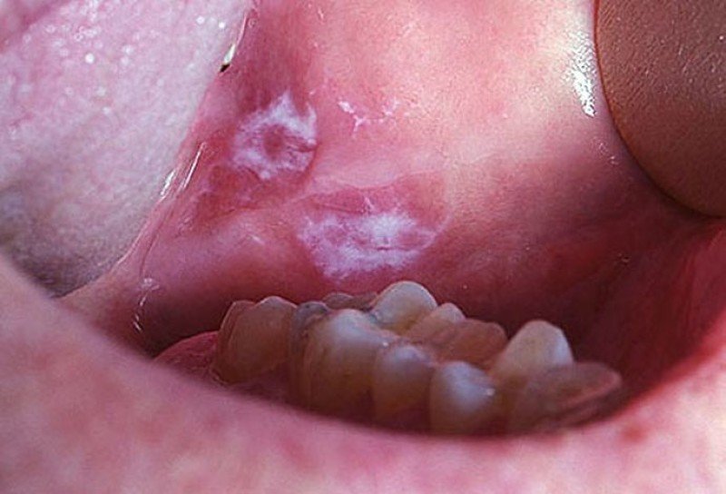 Лейкоплакия полости рта - 1
