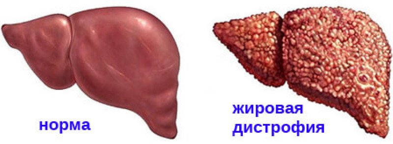 Гепатоз симптомы и лечение. Тиреотоксический гепатоз. Жировой гепатоз и цирроз печени. Гепатоз жировой гепатоз. Гепатоз дистрофия печени.