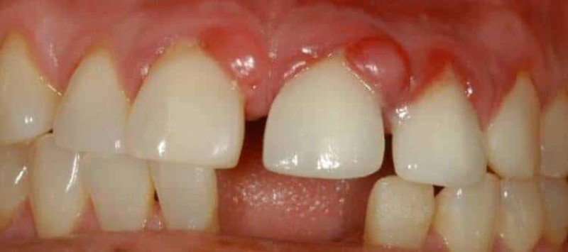 Зубная гранулема - 1