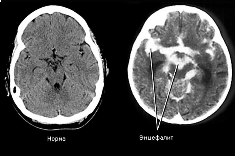 Энцефалит - 2
