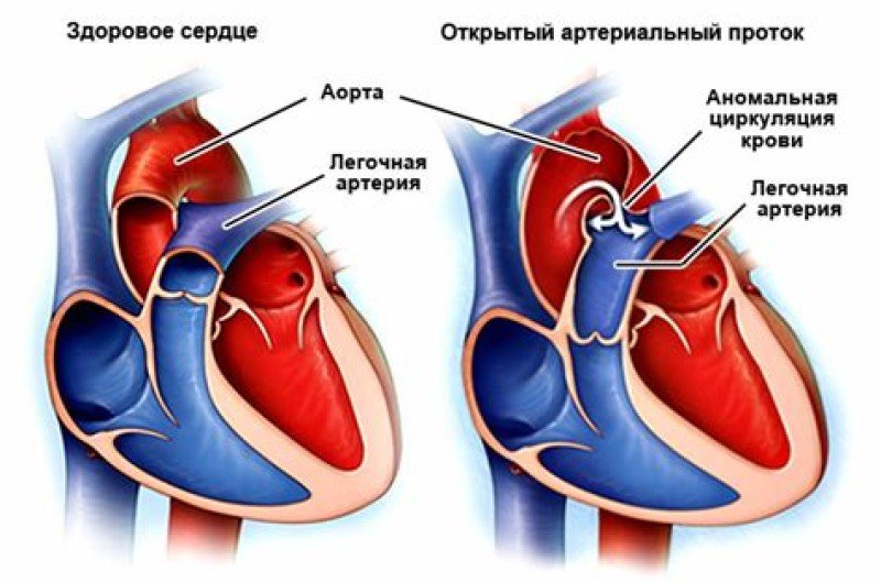Открытый артериальный проток - 2