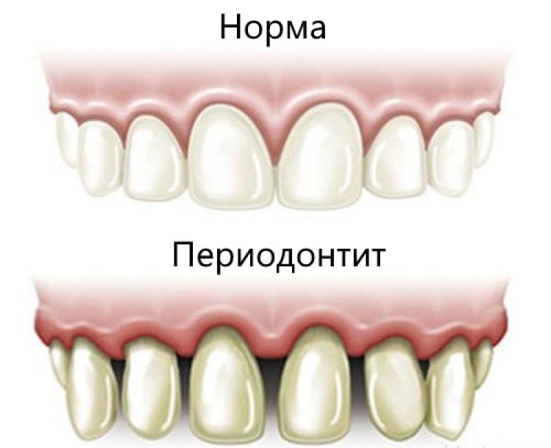 Периодонтит - 2