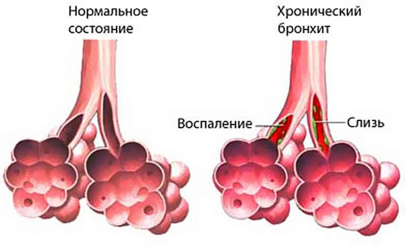 Хронический бронхит - 1