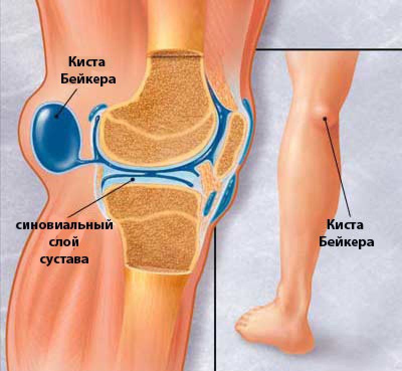 Киста сустава - 2