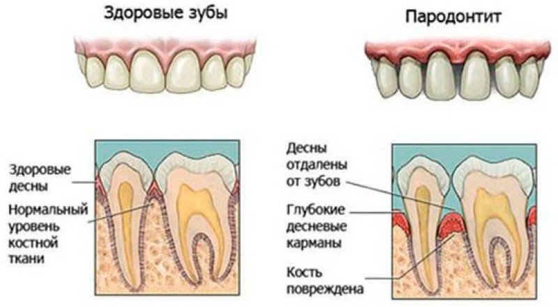 Генерализованный пародонтит (гп) - 2