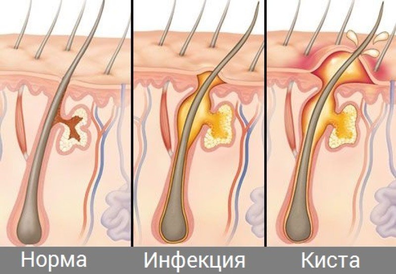 Лечение копчиковой кисты - цена в Санкт-Петербурге | операция в клинике Таурас-Мед Приморский район