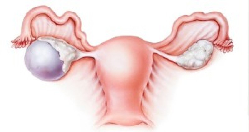 Фиброма яичника (фя) - 1