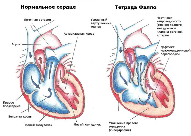 Триада фалло - 1