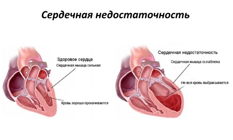 Сердечная недостаточность - 2