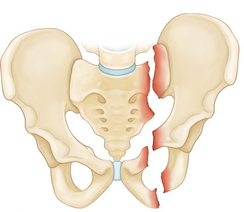 Перелом костей таза - 1