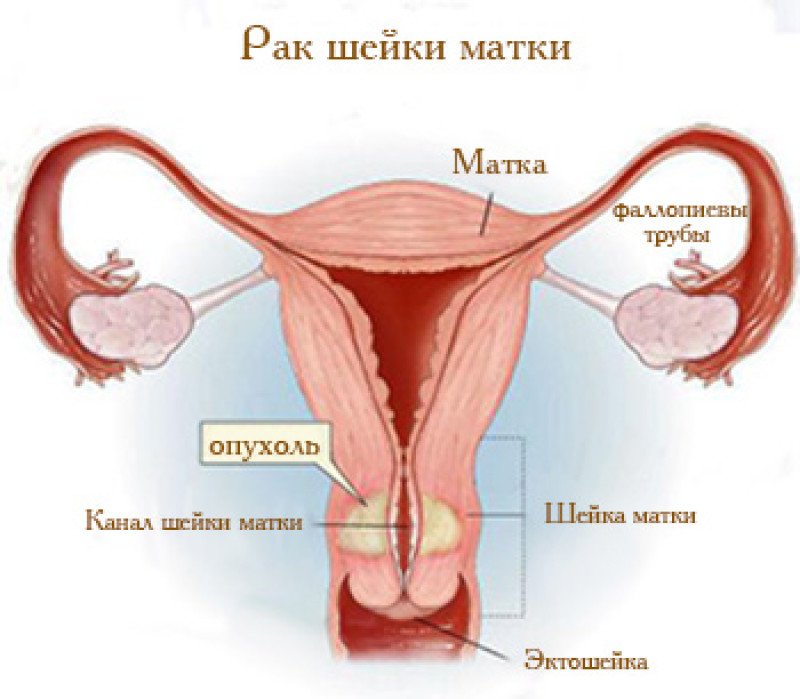 Рак шейки матки - 1