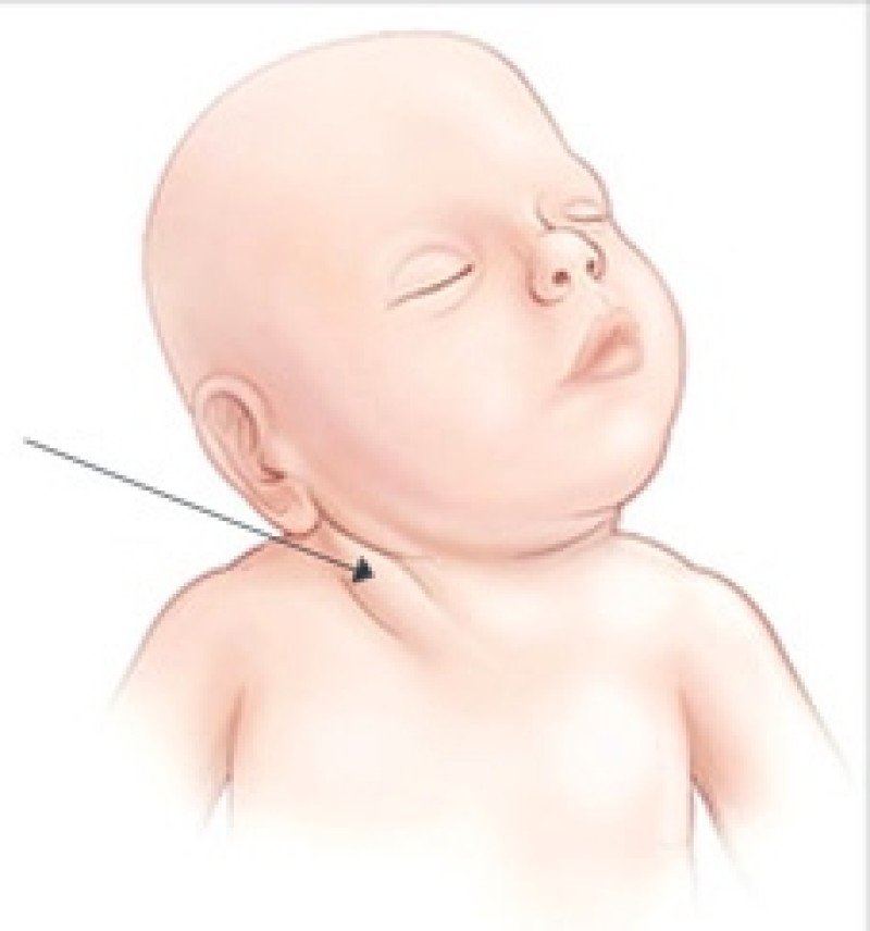 Причины развития кривошеи у малышей