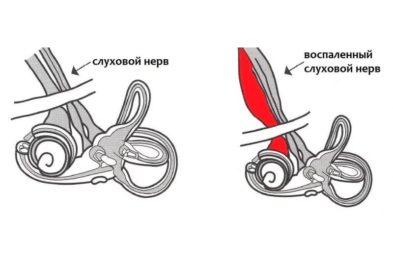 Кохлеарный неврит - 1