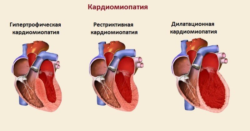 Кардиомиопатия - 2