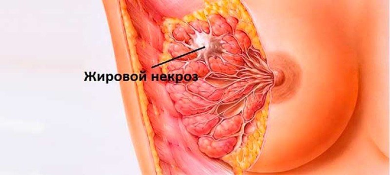 Жировой некроз молочной железы - 2