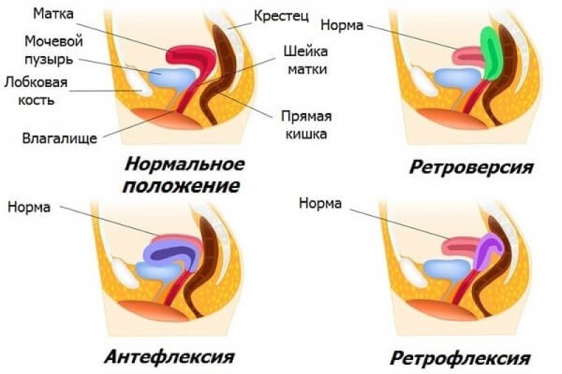 Рeтрофлексия матки - 1